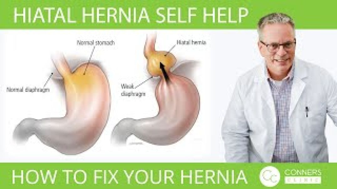 Hiatal Hernia Self-Help